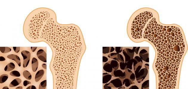 هشاشة العظام: الأسباب والأعراض والعلاج